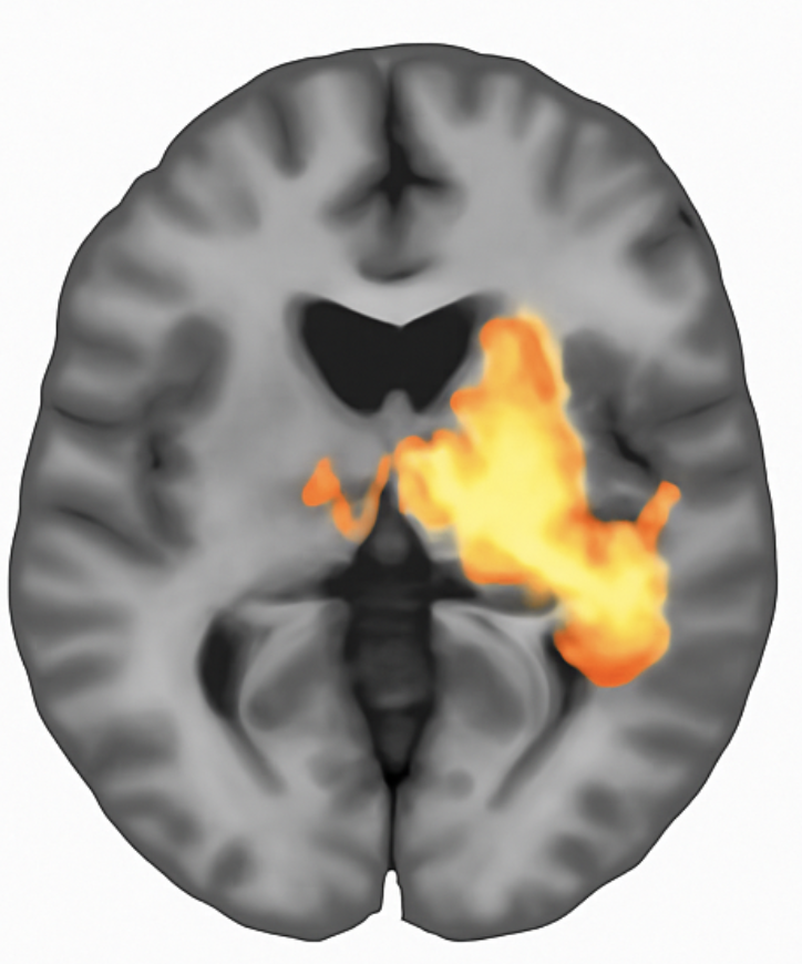 Brain activation map showing GLM results with statistical threshold p < 0.001